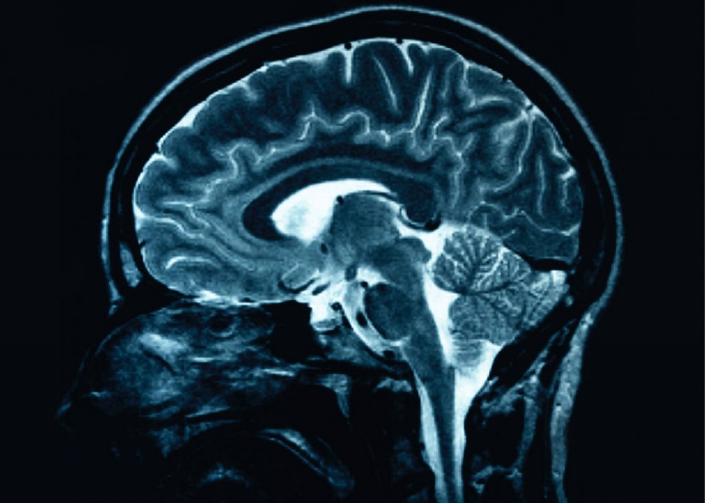 MRI of the brain